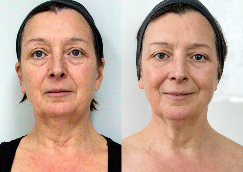 LuxeBeam Pro — Red & Near-Infrared LED Face Mask